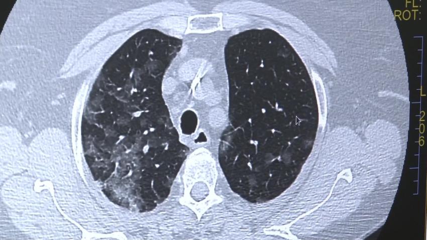 Important! Platformă unică în România pentru a doua opinie în cazul pacienților cu boli pulmonare